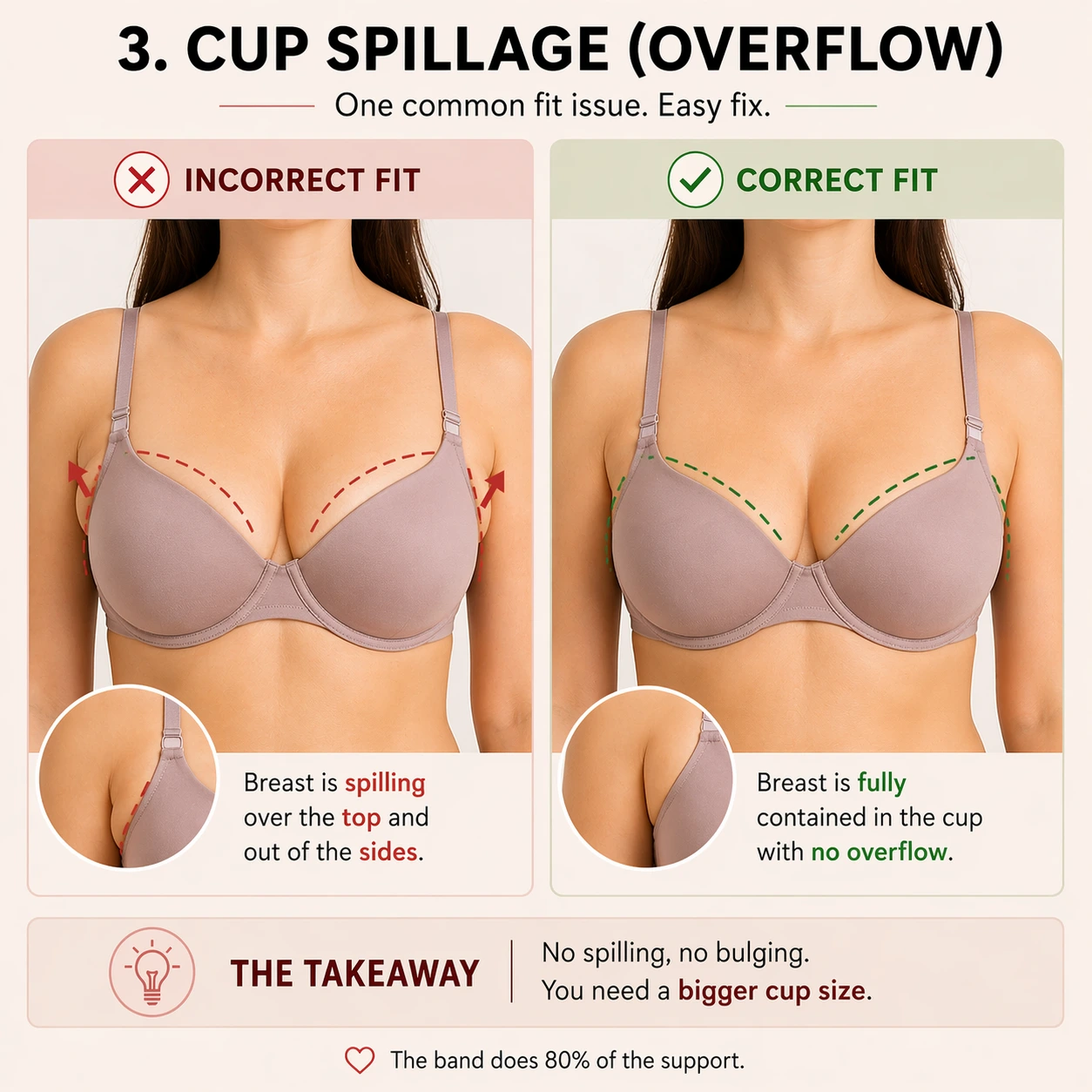 Breast tissue spilling over the top or side edge of a bra cup.